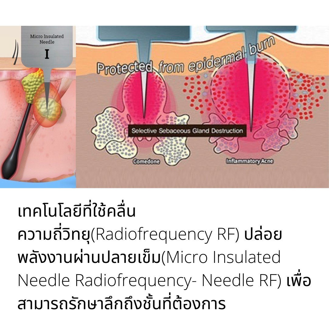 รักษาสิว สิวหิน หลุมสิวด้วยเทคนิคเข็มคลื่นวิทยุทำลายต่อมไขมัน Micro Insulated Needle RF Agness Acne Resolve รักษาสิว สิวหิน หลุมสิวด้วยเทคนิคเข็มคลื่นวิทยุทำลายต่อมไขมัน Micro Insulated Needle RF Agness Acne Resolve