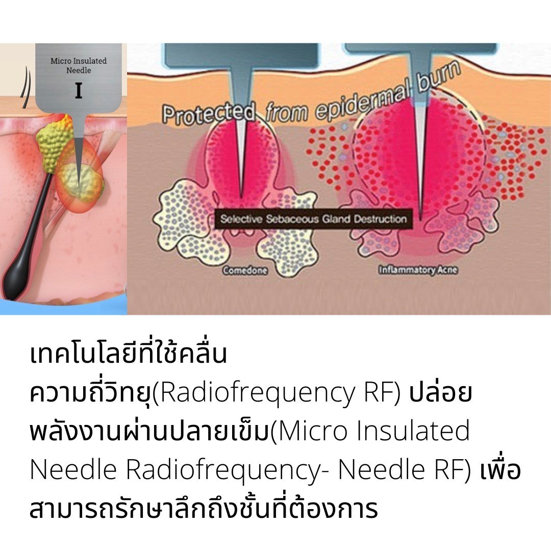 รักษาสิว สิวหิน หลุมสิวด้วยเทคนิคเข็มคลื่นวิทยุทำลายต่อมไขมัน Micro Insulated Needle RF Agness Acne Resolve