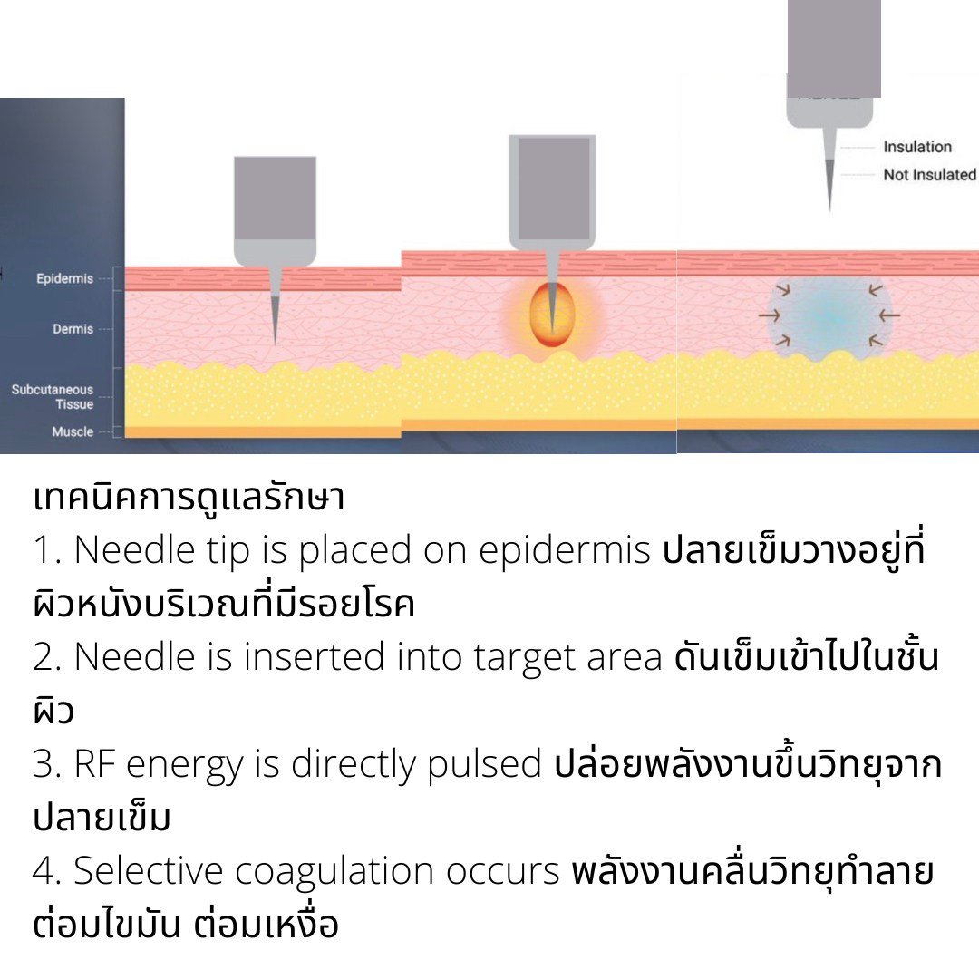 รักษาสิว สิวหิน หลุมสิวด้วยเทคนิคเข็มคลื่นวิทยุทำลายต่อมไขมัน Micro Insulated Needle RF Agness Acne Resolve