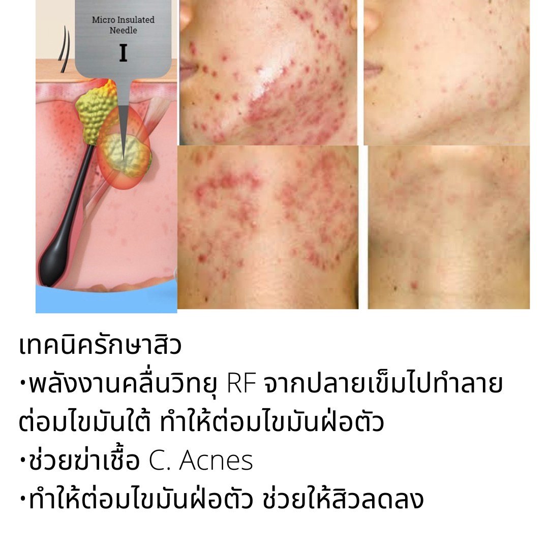 รักษาสิว สิวหิน หลุมสิวด้วยเทคนิคเข็มคลื่นวิทยุทำลายต่อมไขมัน Micro Insulated Needle RF Agness Acne Resolve รักษาสิว สิวหิน หลุมสิวด้วยเทคนิคเข็มคลื่นวิทยุทำลายต่อมไขมัน Micro Insulated Needle RF Agness Acne Resolve