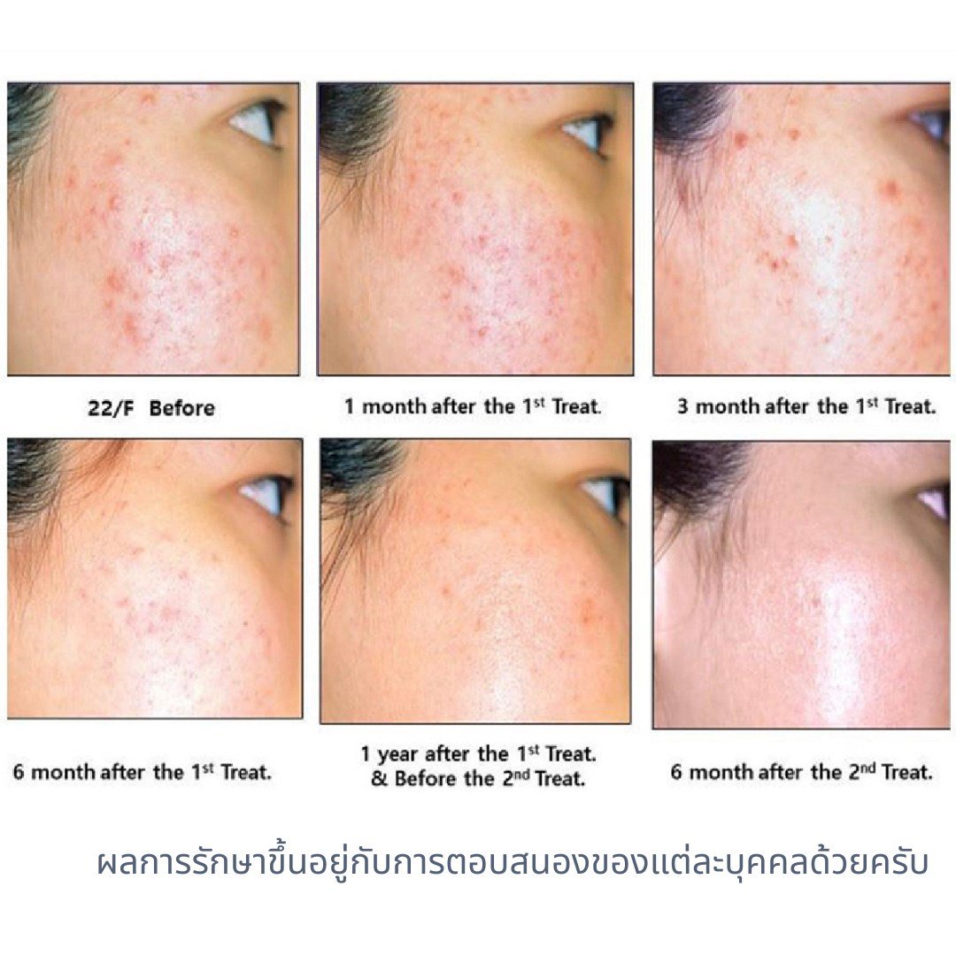 รักษาสิว สิวหิน หลุมสิวด้วยเทคนิคเข็มคลื่นวิทยุทำลายต่อมไขมัน Micro Insulated Needle RF Agness Acne Resolve รักษาสิว สิวหิน หลุมสิวด้วยเทคนิคเข็มคลื่นวิทยุทำลายต่อมไขมัน Micro Insulated Needle RF Agness Acne Resolve