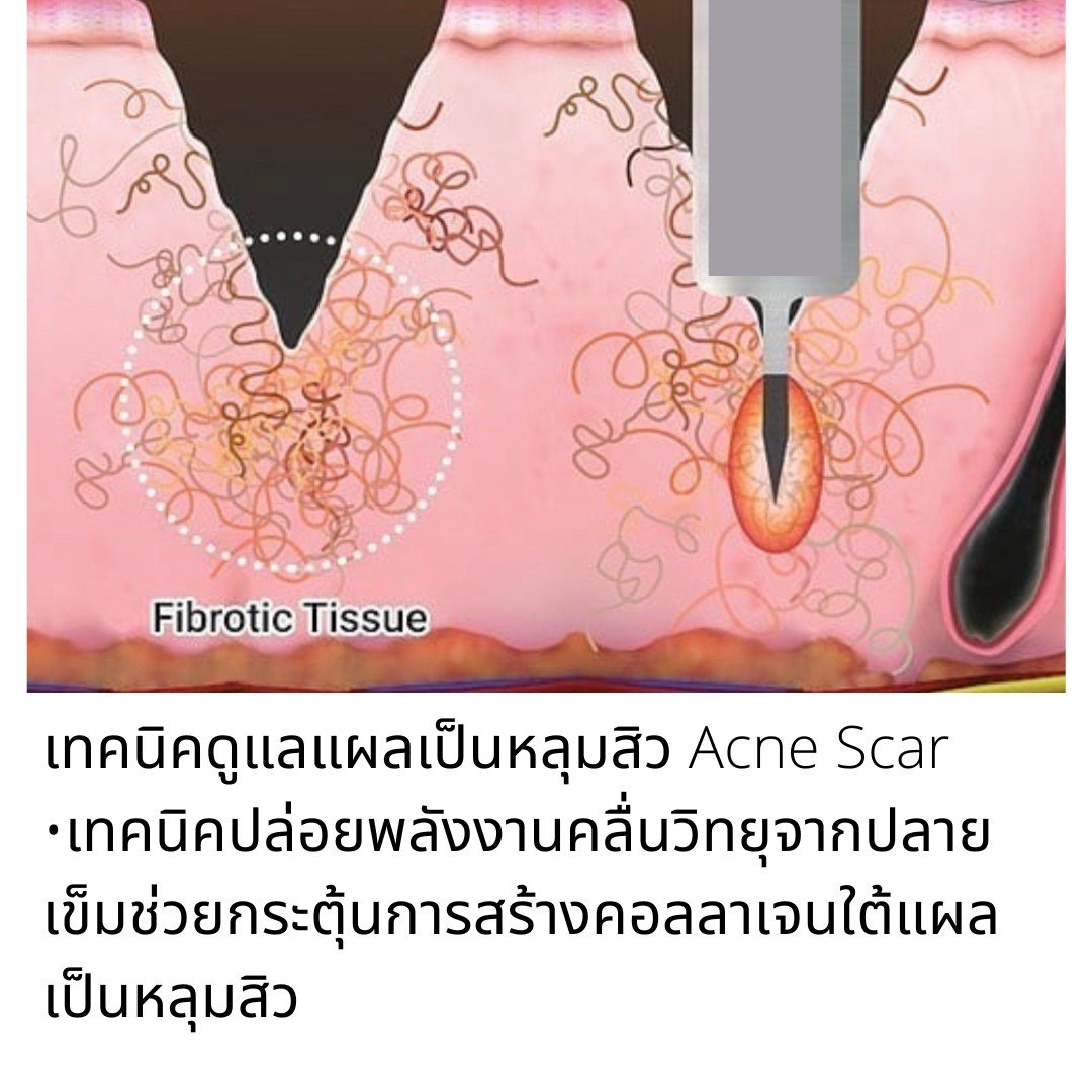 รักษาสิว สิวหิน หลุมสิวด้วยเทคนิคเข็มคลื่นวิทยุทำลายต่อมไขมัน Micro Insulated Needle RF Agness Acne Resolve