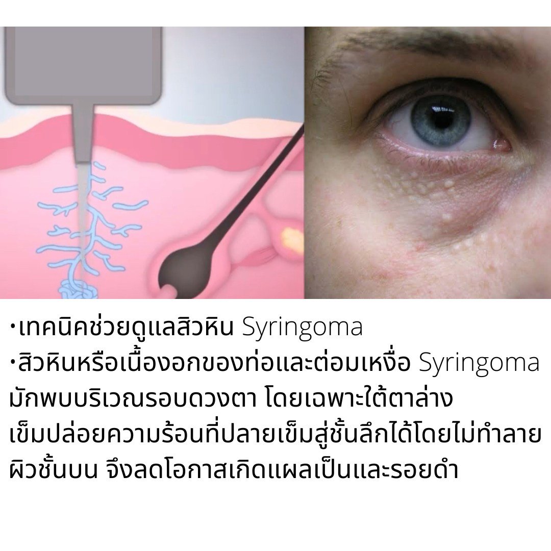 รักษาสิว สิวหิน หลุมสิวด้วยเทคนิคเข็มคลื่นวิทยุทำลายต่อมไขมัน Micro Insulated Needle RF Agness Acne Resolve รักษาสิว สิวหิน หลุมสิวด้วยเทคนิคเข็มคลื่นวิทยุทำลายต่อมไขมัน Micro Insulated Needle RF Agness Acne Resolve