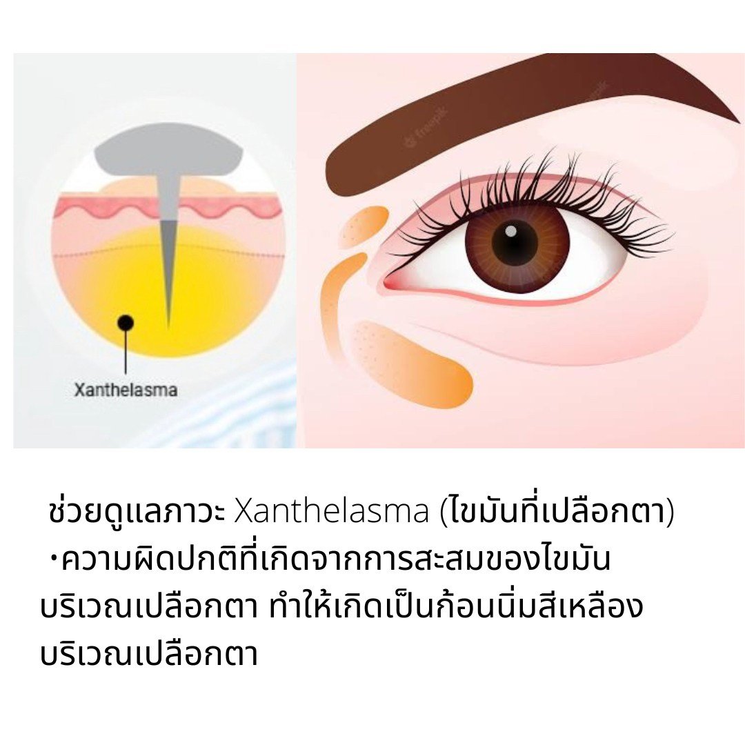 รักษาสิว สิวหิน หลุมสิวด้วยเทคนิคเข็มคลื่นวิทยุทำลายต่อมไขมัน Micro Insulated Needle RF Agness Acne Resolve รักษาสิว สิวหิน หลุมสิวด้วยเทคนิคเข็มคลื่นวิทยุทำลายต่อมไขมัน Micro Insulated Needle RF Agness Acne Resolve