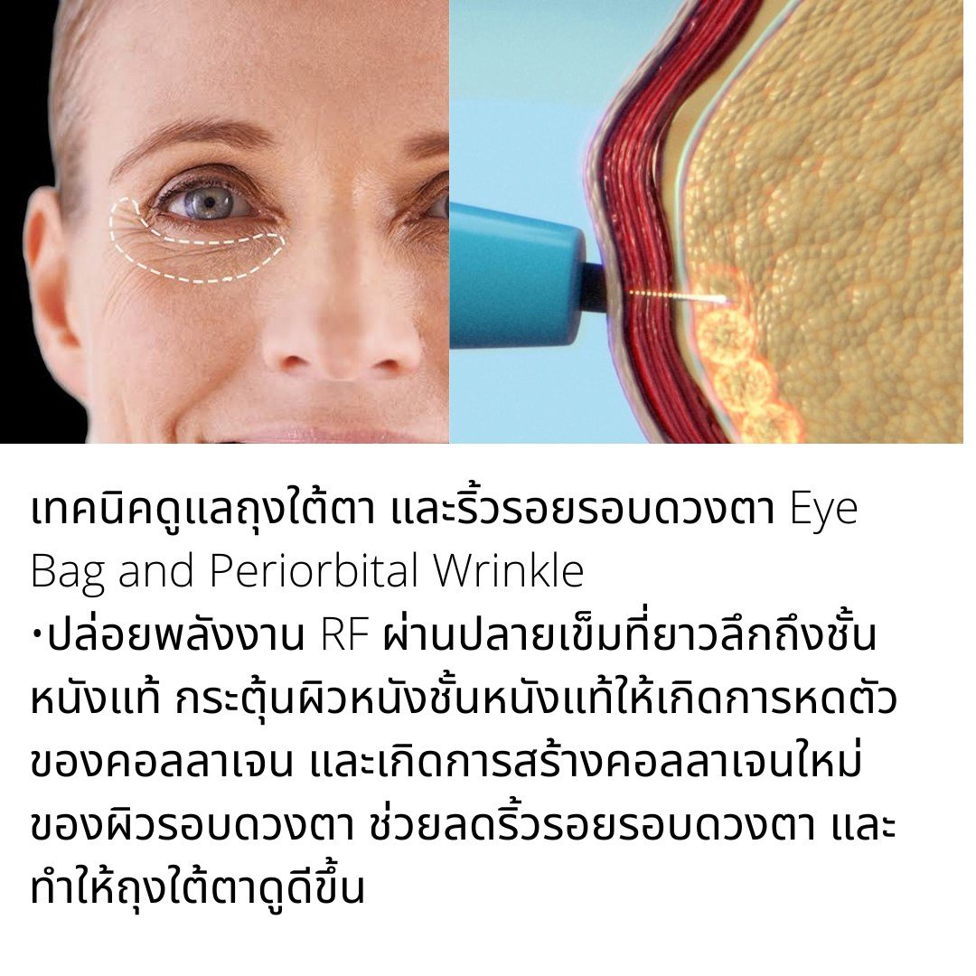 รักษาสิว สิวหิน หลุมสิวด้วยเทคนิคเข็มคลื่นวิทยุทำลายต่อมไขมัน Micro Insulated Needle RF Agness Acne Resolve รักษาสิว สิวหิน หลุมสิวด้วยเทคนิคเข็มคลื่นวิทยุทำลายต่อมไขมัน Micro Insulated Needle RF Agness Acne Resolve