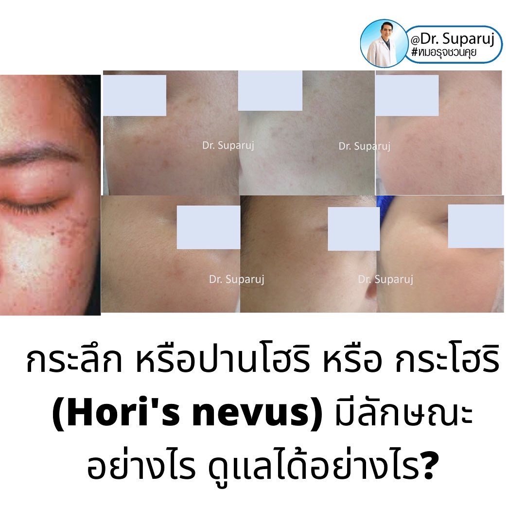 กระลึก หรือปานโฮริ หรือ กระโฮริ (Hori's nevus) มีลักษณะอย่างไร รักษาได้อย่างไร?