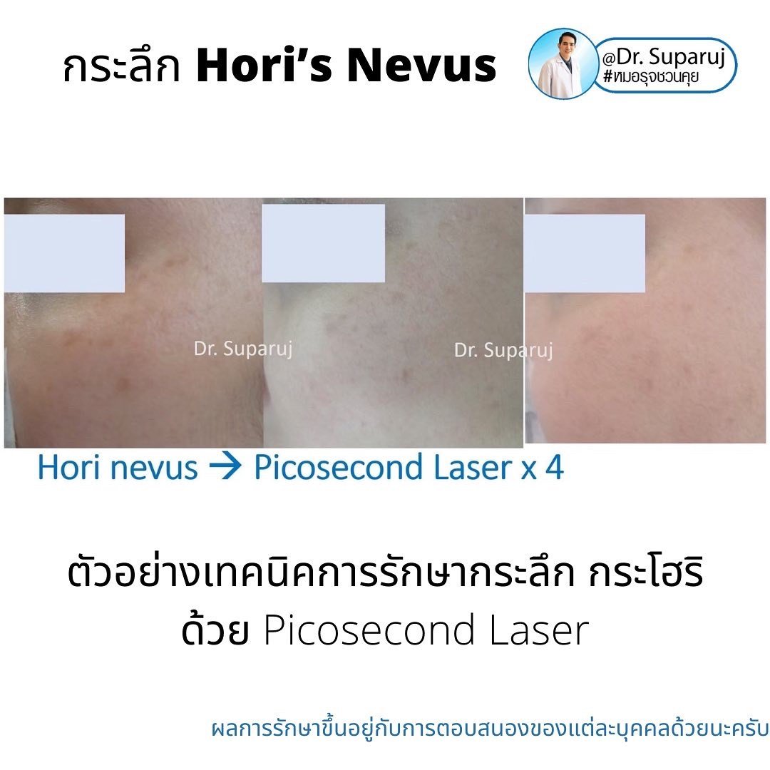 กระลึก หรือปานโฮริ หรือ กระโฮริ (Hori's nevus) มีลักษณะอย่างไร รักษาได้อย่างไร? กระลึก หรือปานโฮริ หรือ กระโฮริ (Hori's nevus) มีลักษณะอย่างไร รักษาได้อย่างไร?