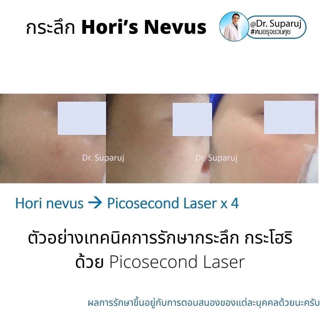 กระลึก หรือปานโฮริ หรือ กระโฮริ (Hori's nevus) มีลักษณะอย่างไร รักษาได้อย่างไร? กระลึก หรือปานโฮริ หรือ กระโฮริ (Hori's nevus) มีลักษณะอย่างไร รักษาได้อย่างไร?