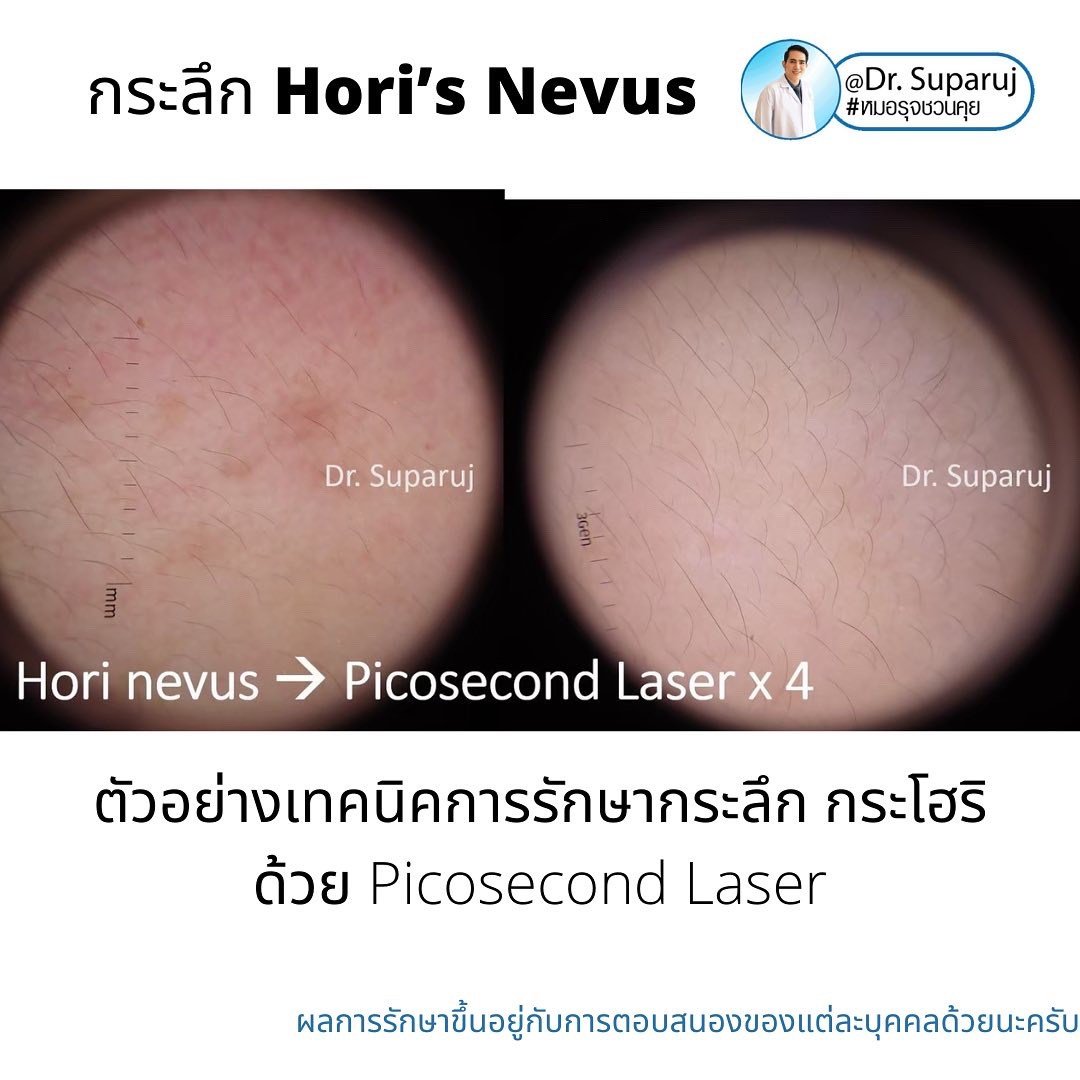 กระลึก หรือปานโฮริ หรือ กระโฮริ (Hori's nevus) มีลักษณะอย่างไร รักษาได้อย่างไร? กระลึก หรือปานโฮริ หรือ กระโฮริ (Hori's nevus) มีลักษณะอย่างไร รักษาได้อย่างไร?