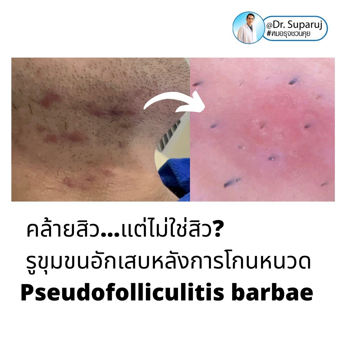 เทคนิคการโกนหนวดและดูแลผิวเพื่อลดการเกิด รูขุมขนอักเสบหลังการโกนหนวด Pseudofolliculitis barbae, Razor bump เทคนิคการโกนหนวดและดูแลผิวเพื่อลดการเกิด รูขุมขนอักเสบหลังการโกนหนวด Pseudofolliculitis barbae, Razor bump