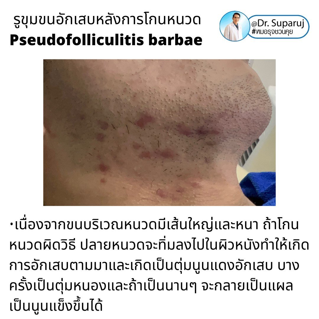 เทคนิคการโกนหนวดและดูแลผิวเพื่อลดการเกิด รูขุมขนอักเสบหลังการโกนหนวด Pseudofolliculitis barbae, Razor bump เทคนิคการโกนหนวดและดูแลผิวเพื่อลดการเกิด รูขุมขนอักเสบหลังการโกนหนวด Pseudofolliculitis barbae, Razor bump