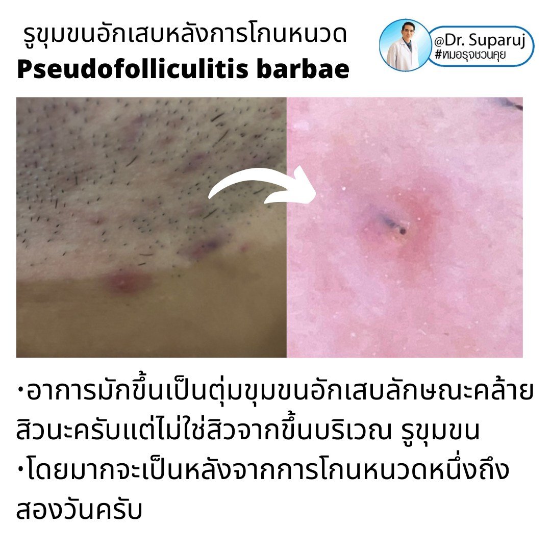 เทคนิคการโกนหนวดและดูแลผิวเพื่อลดการเกิด รูขุมขนอักเสบหลังการโกนหนวด Pseudofolliculitis barbae, Razor bump เทคนิคการโกนหนวดและดูแลผิวเพื่อลดการเกิด รูขุมขนอักเสบหลังการโกนหนวด Pseudofolliculitis barbae, Razor bump