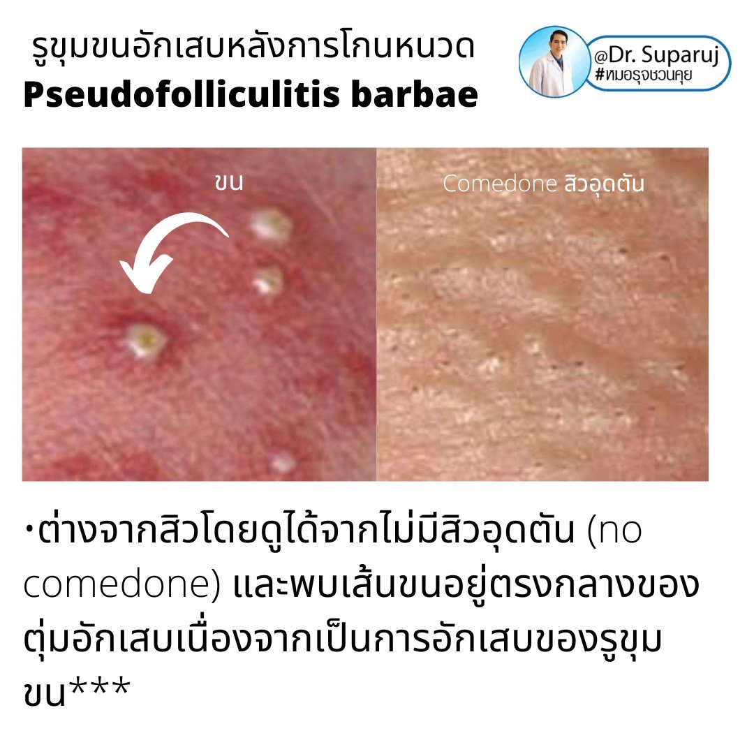 เทคนิคการโกนหนวดและดูแลผิวเพื่อลดการเกิด รูขุมขนอักเสบหลังการโกนหนวด Pseudofolliculitis barbae, Razor bump เทคนิคการโกนหนวดและดูแลผิวเพื่อลดการเกิด รูขุมขนอักเสบหลังการโกนหนวด Pseudofolliculitis barbae, Razor bump