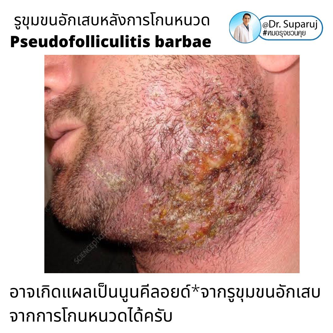 เทคนิคการโกนหนวดและดูแลผิวเพื่อลดการเกิด รูขุมขนอักเสบหลังการโกนหนวด Pseudofolliculitis barbae, Razor bump เทคนิคการโกนหนวดและดูแลผิวเพื่อลดการเกิด รูขุมขนอักเสบหลังการโกนหนวด Pseudofolliculitis barbae, Razor bump