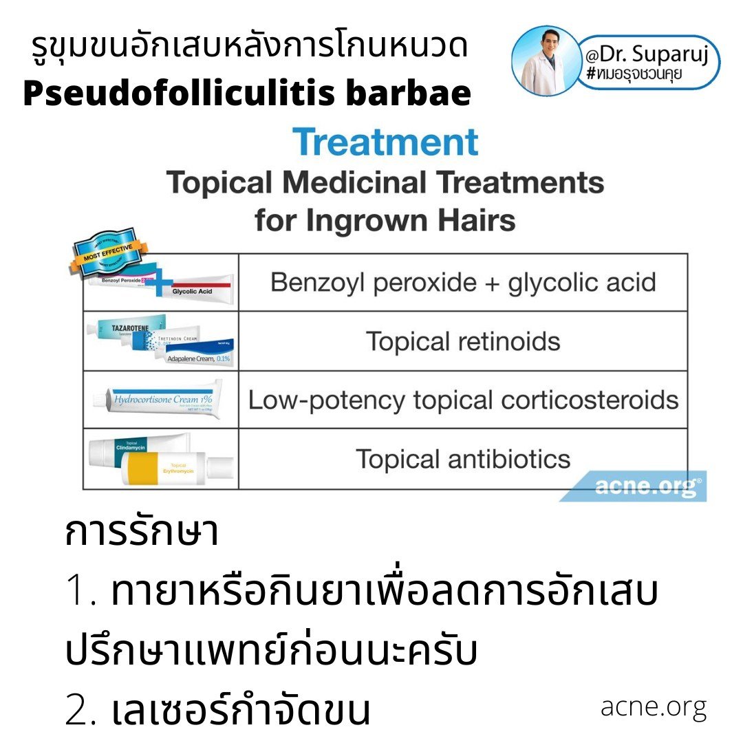 เทคนิคการโกนหนวดและดูแลผิวเพื่อลดการเกิด รูขุมขนอักเสบหลังการโกนหนวด Pseudofolliculitis barbae, Razor bump