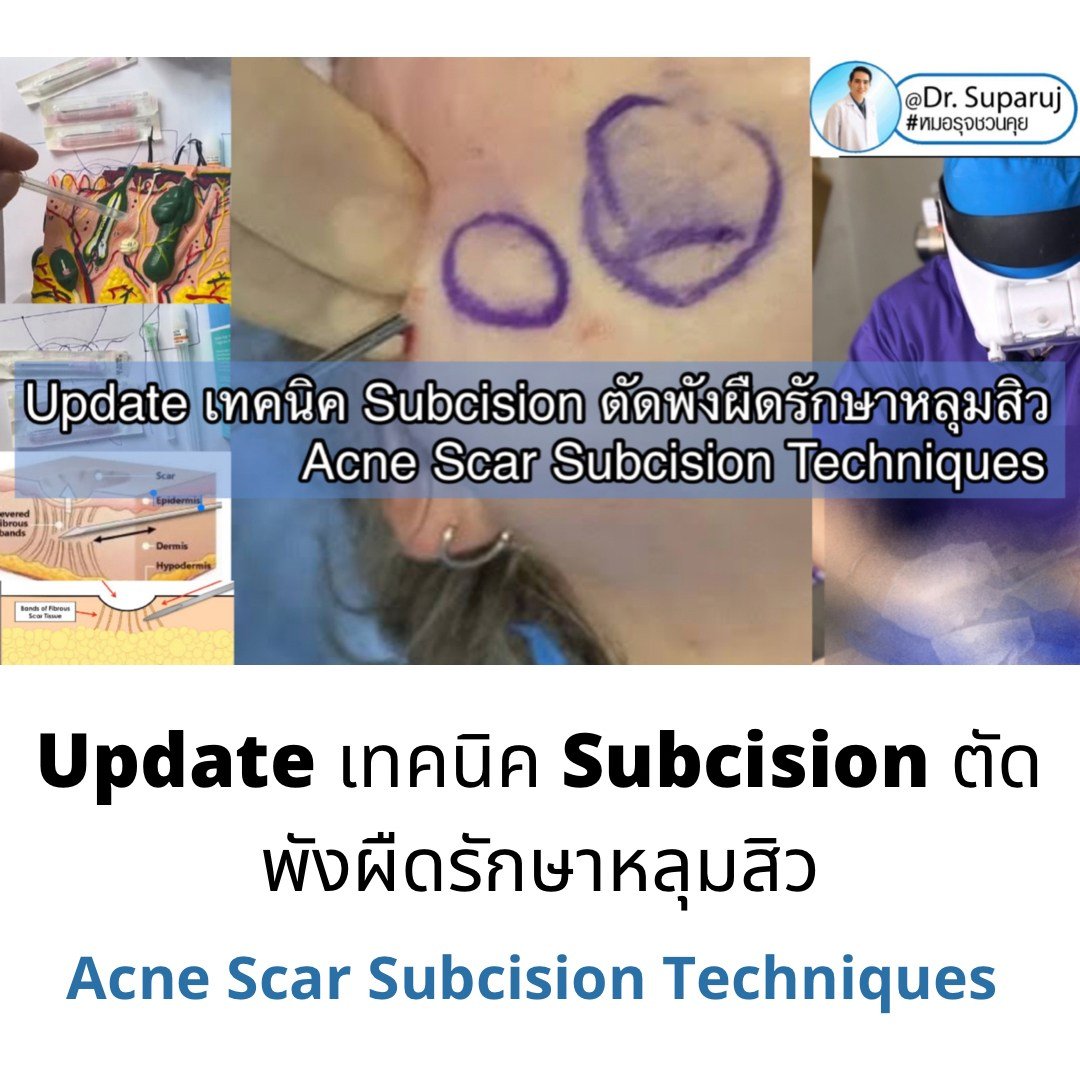 Update เทคนิค Subcision ตัดพังผืดรักษาหลุมสิว Acne Scar Subcision Techniques