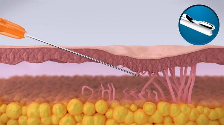 Update เทคนิค Subcision ตัดพังผืดรักษาหลุมสิว Acne Scar Subcision Techniques