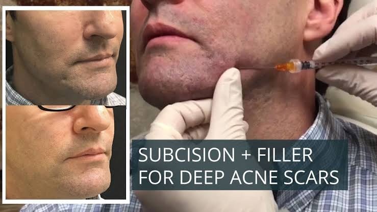 Update เทคนิค Subcision ตัดพังผืดรักษาหลุมสิว Acne Scar Subcision Techniques Update เทคนิค Subcision ตัดพังผืดรักษาหลุมสิว Acne Scar Subcision Techniques