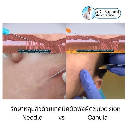 Update เทคนิค Subcision ตัดพังผืดรักษาหลุมสิว Acne Scar Subcision Techniques Update เทคนิค Subcision ตัดพังผืดรักษาหลุมสิว Acne Scar Subcision Techniques