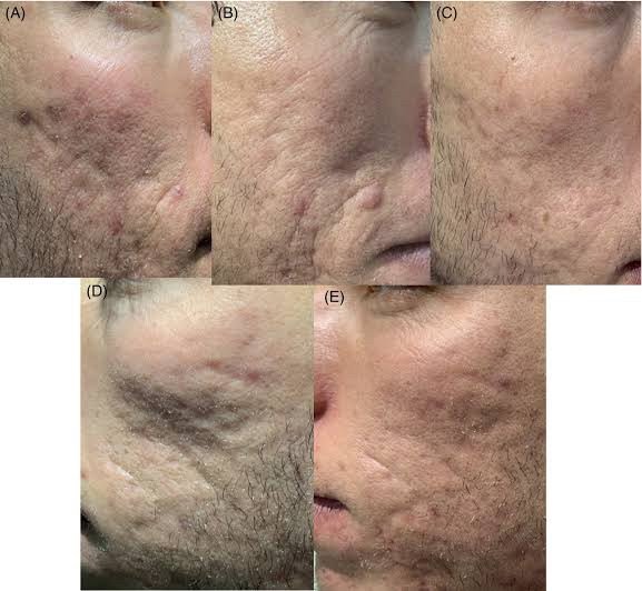 Update เทคนิค Subcision ตัดพังผืดรักษาหลุมสิว Acne Scar Subcision Techniques Update เทคนิค Subcision ตัดพังผืดรักษาหลุมสิว Acne Scar Subcision Techniques