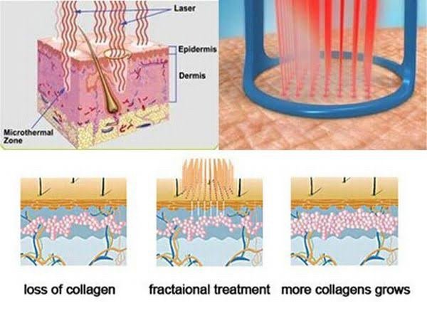 รักษาหลุมสิวด้วยเลเซอร์ Fractional Carbon Dioxide CO2 Laser (FxCO2) ในคนไทย ได้ผลดีไหม ต้องระวังอะไรบ้าง และ เทคนิคการดูแลผิวหลังทำเลเซอร์ ? รักษาหลุมสิวด้วยเลเซอร์ Fractional Carbon Dioxide CO2 Laser (FxCO2) ในคนไทย ได้ผลดีไหม ต้องระวังอะไรบ้าง และ เทคนิคการดูแลผิวหลังทำเลเซอร์ ?