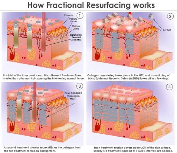 รักษาหลุมสิวด้วยเลเซอร์ Fractional Carbon Dioxide CO2 Laser (FxCO2) ในคนไทย ได้ผลดีไหม ต้องระวังอะไรบ้าง และ เทคนิคการดูแลผิวหลังทำเลเซอร์ ? รักษาหลุมสิวด้วยเลเซอร์ Fractional Carbon Dioxide CO2 Laser (FxCO2) ในคนไทย ได้ผลดีไหม ต้องระวังอะไรบ้าง และ เทคนิคการดูแลผิวหลังทำเลเซอร์ ?