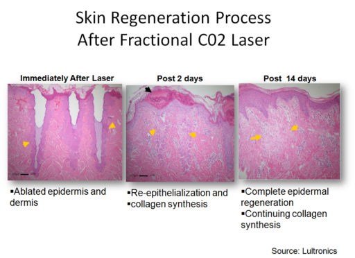 รักษาหลุมสิวด้วยเลเซอร์ Fractional Carbon Dioxide CO2 Laser (FxCO2) ในคนไทย ได้ผลดีไหม ต้องระวังอะไรบ้าง และ เทคนิคการดูแลผิวหลังทำเลเซอร์ ? รักษาหลุมสิวด้วยเลเซอร์ Fractional Carbon Dioxide CO2 Laser (FxCO2) ในคนไทย ได้ผลดีไหม ต้องระวังอะไรบ้าง และ เทคนิคการดูแลผิวหลังทำเลเซอร์ ?