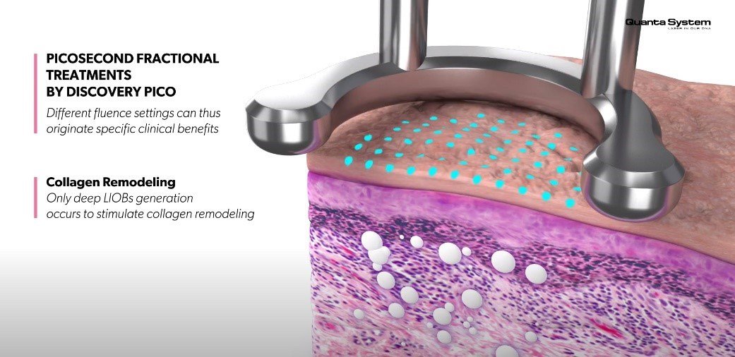 รักษาหลุมสิวด้วยเลเซอร์ Picosecond Laser และ Fractional CO2 Laser มีเทคนิคต่างกันอย่างไร ชนิดไหนได้ผลดีกว่า?