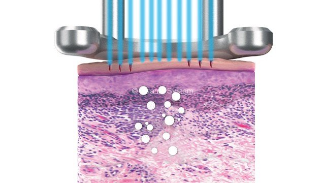 รักษาหลุมสิวด้วยเลเซอร์ Picosecond Laser และ Fractional CO2 Laser มีเทคนิคต่างกันอย่างไร ชนิดไหนได้ผลดีกว่า?