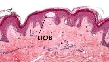 รักษาหลุมสิวด้วยเลเซอร์ Picosecond Laser และ Fractional CO2 Laser มีเทคนิคต่างกันอย่างไร ชนิดไหนได้ผลดีกว่า? รักษาหลุมสิวด้วยเลเซอร์ Picosecond Laser และ Fractional CO2 Laser มีเทคนิคต่างกันอย่างไร ชนิดไหนได้ผลดีกว่า?