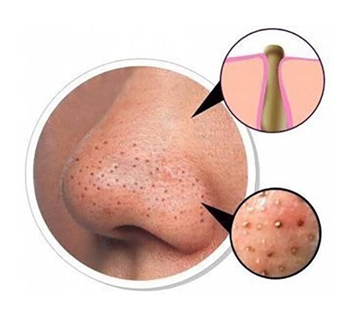 แผลเป็นหลุมสิวที่จมูก ดูแลได้อย่างไรบ้าง ? แผลเป็นหลุมสิวที่จมูก ดูแลได้อย่างไรบ้าง ?