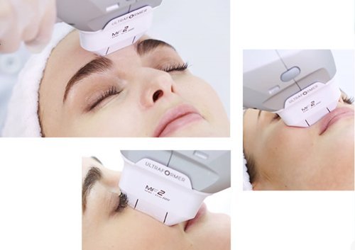 Ultraformer III Ultra HIFU นวัตกรรมใหม่ล่าสุดของการยกกระชับ คอร์ส 3 ครั้ง 19,000 บ. Ultraformer III Ultra HIFU นวัตกรรมใหม่ล่าสุดของการยกกระชับ คอร์ส 3 ครั้ง 19,000 บ.