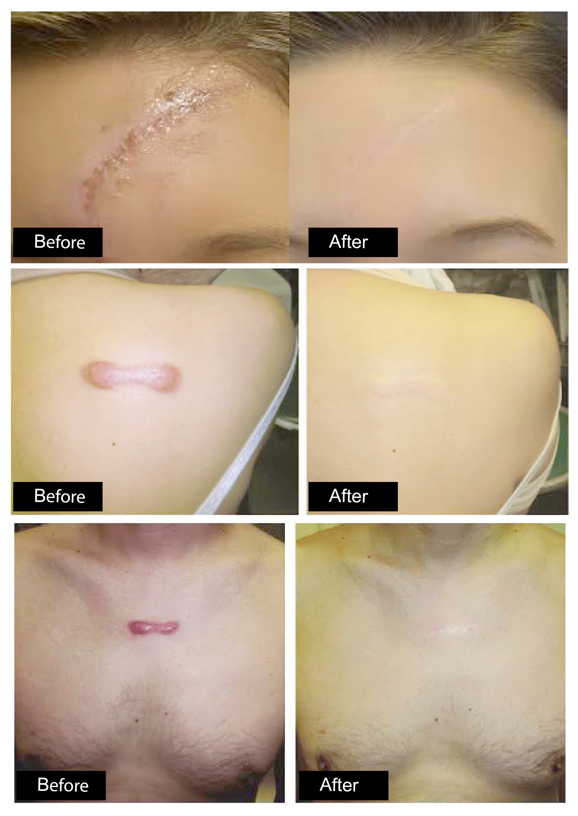 ดูแลแผลเป็นนูน คีลอยด์ ด้วยเทคนิค Triple Laser Therapy: Picosecond Laser + Gold Toning + Fractional Laser + ฉีดยา Intralesional In ดูแลแผลเป็นนูน คีลอยด์ ด้วยเทคนิค Triple Laser Therapy: Picosecond Laser + Gold Toning + Fractional Laser + ฉีดยา Intralesional In