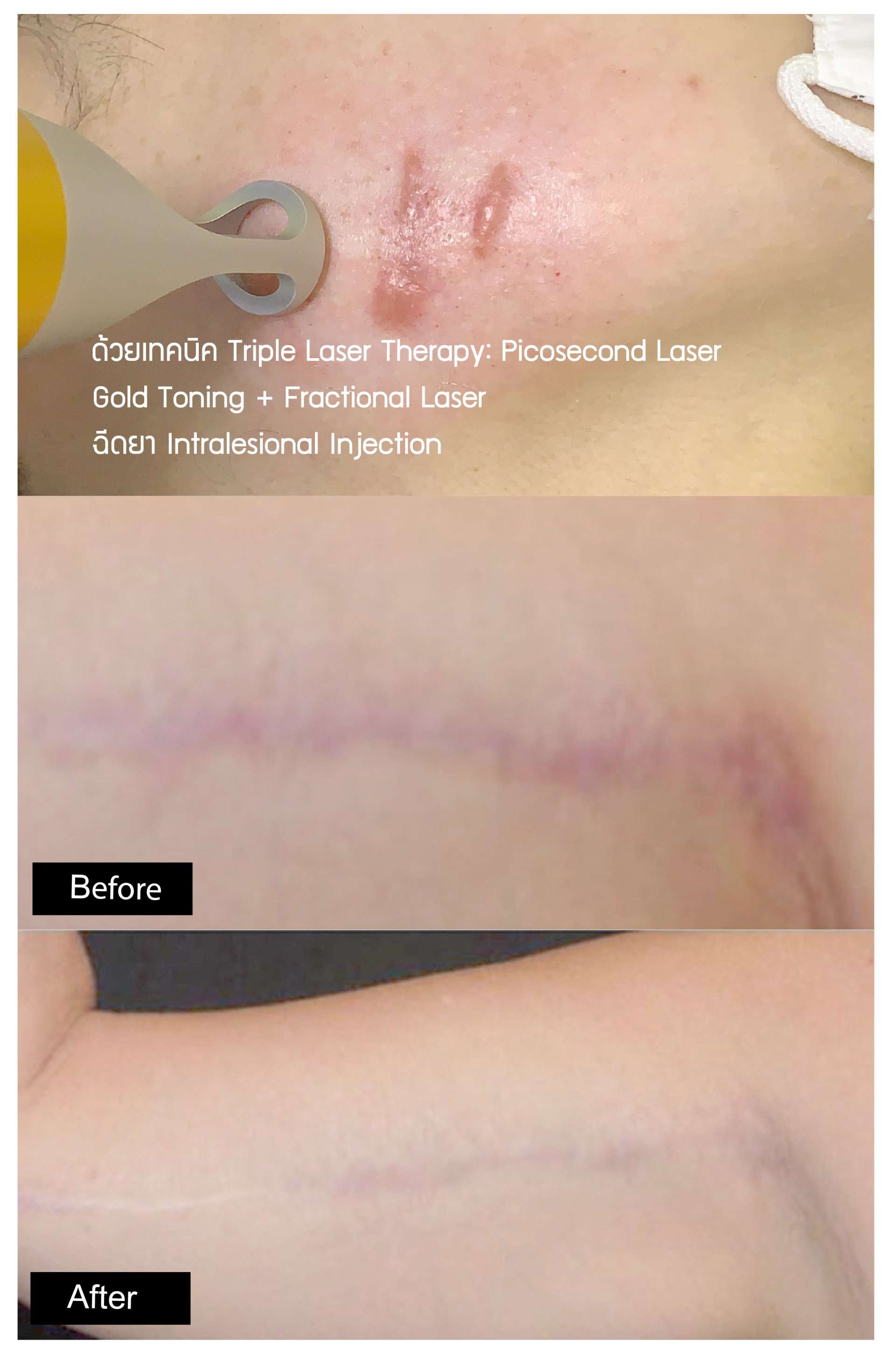 ดูแลแผลเป็นนูน คีลอยด์ ด้วยเทคนิค Triple Laser Therapy: Picosecond Laser + Gold Toning + Fractional Laser + ฉีดยา Intralesional In ดูแลแผลเป็นนูน คีลอยด์ ด้วยเทคนิค Triple Laser Therapy: Picosecond Laser + Gold Toning + Fractional Laser + ฉีดยา Intralesional In