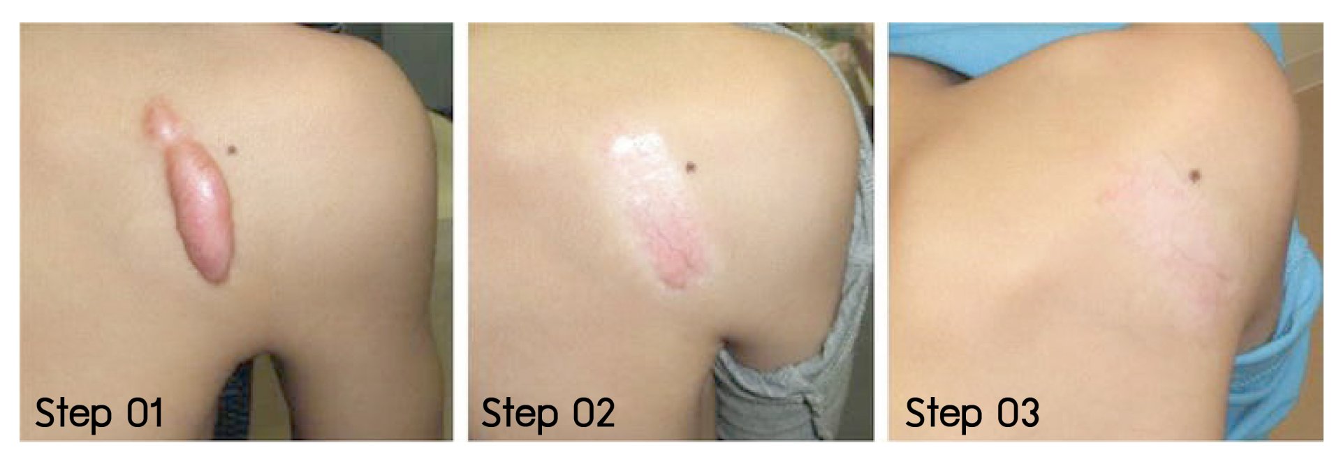 ดูแลแผลเป็นนูน คีลอยด์ ด้วยเทคนิค Triple Laser Therapy: Picosecond Laser + Gold Toning + Fractional Laser + ฉีดยา Intralesional In ดูแลแผลเป็นนูน คีลอยด์ ด้วยเทคนิค Triple Laser Therapy: Picosecond Laser + Gold Toning + Fractional Laser + ฉีดยา Intralesional In