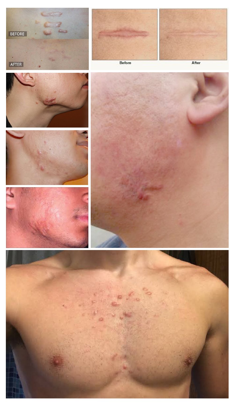 แผลเป็นชนิดนูน Keloid จากการเป็นสิว Keloidal acne scar