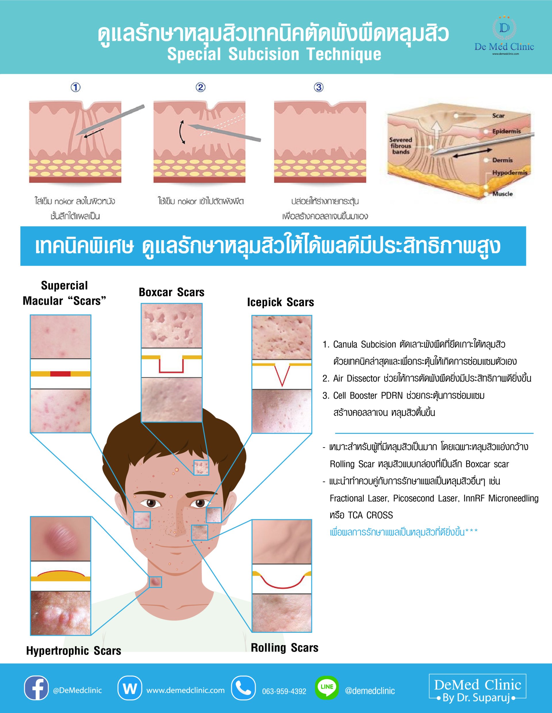 ดูแลแผลเป็นจากสิว Acne Scar ได้อย่างไรบ้าง หมอรุจมีคำตอบ ? ดูแลแผลเป็นจากสิว Acne Scar ได้อย่างไรบ้าง หมอรุจมีคำตอบ ?
