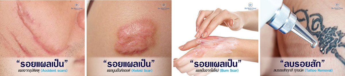 การรักษารอยแผลเป็นแบบหลุมจากสิว Atrophic Acne Scar ด้วยการผ่าตัด Scar Revision คืออะไร ?