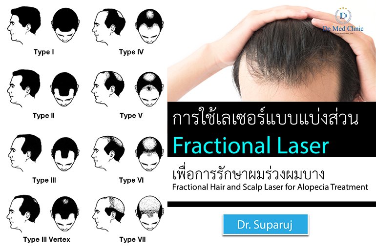 การใช้เลเซอร์แบบแบ่งส่วน Fractional Laser เพื่อการรักษาผมร่วงผมบาง Fractional Hair and Scalp Laser for Alopecia Treatment 