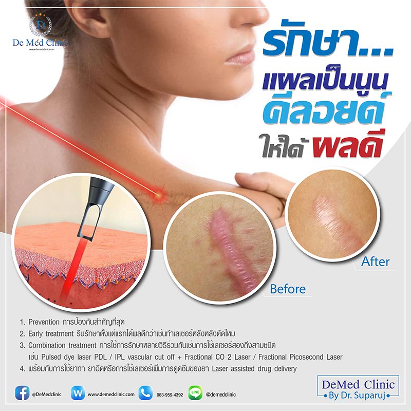 รักษาแผลเป็นนูน คีลอยด์ ให้ได้ผลดี update 2020 รักษาแผลเป็นนูน คีลอยด์ ให้ได้ผลดี update 2020