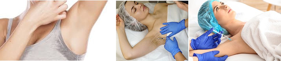 การฉีดโบทูลินั่มท็อกซินลดเหงื่อ Botulinum Toxin for Axillary Hyperhidrosis Treatmentรอยแดงจากสิว เกิดจากอะไร และรักษาได้อย่างไร ?เทคนิคดูแลแผลเป็นนูน คีลอยด์ Keloid ด้วยเลเซอร์ Triple Laser Therapy Picosecond Gold Toning Fractional Laser การฉีดโบทูลินั่มท็อกซินลดเหงื่อ Botulinum Toxin for Axillary Hyperhidrosis Treatmentรอยแดงจากสิว เกิดจากอะไร และรักษาได้อย่างไร ?เทคนิคดูแลแผลเป็นนูน คีลอยด์ Keloid ด้วยเลเซอร์ Triple Laser Therapy Picosecond Gold Toning Fractional Laser