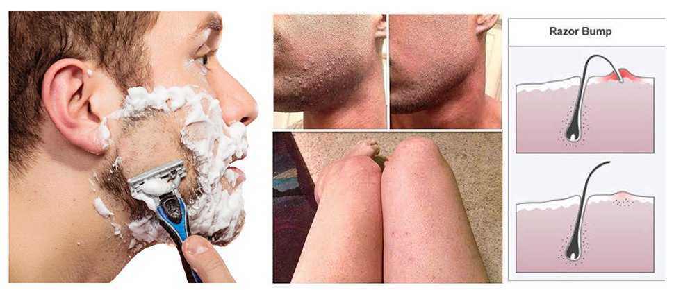 รูขุมขนอักเสบจากการโกนหนวด Pseudofolliculitis barbe รูขุมขนอักเสบจากการโกนหนวด Pseudofolliculitis barbe