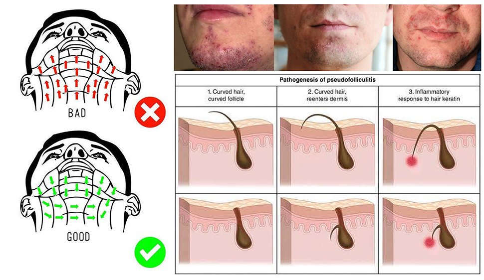 รูขุมขนอักเสบจากการโกนหนวด Pseudofolliculitis barbe รูขุมขนอักเสบจากการโกนหนวด Pseudofolliculitis barbe