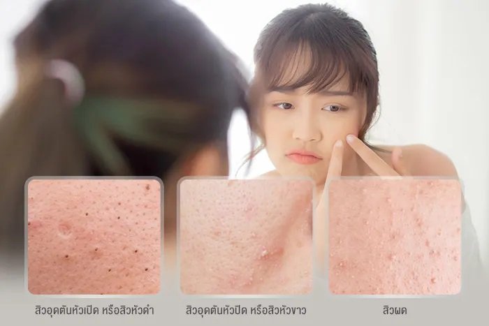 เป็นสิวจากการใส่หน้ากากอนามัยทำอย่างไรดี เป็นสิวจากการใส่หน้ากากอนามัยทำอย่างไรดี