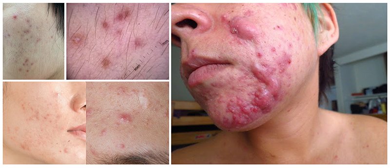 รอยแดงจากสิวเกิดจากอะไรและรักษาได้อย่างไร ? รอยแดงจากสิวเกิดจากอะไรและรักษาได้อย่างไร ?