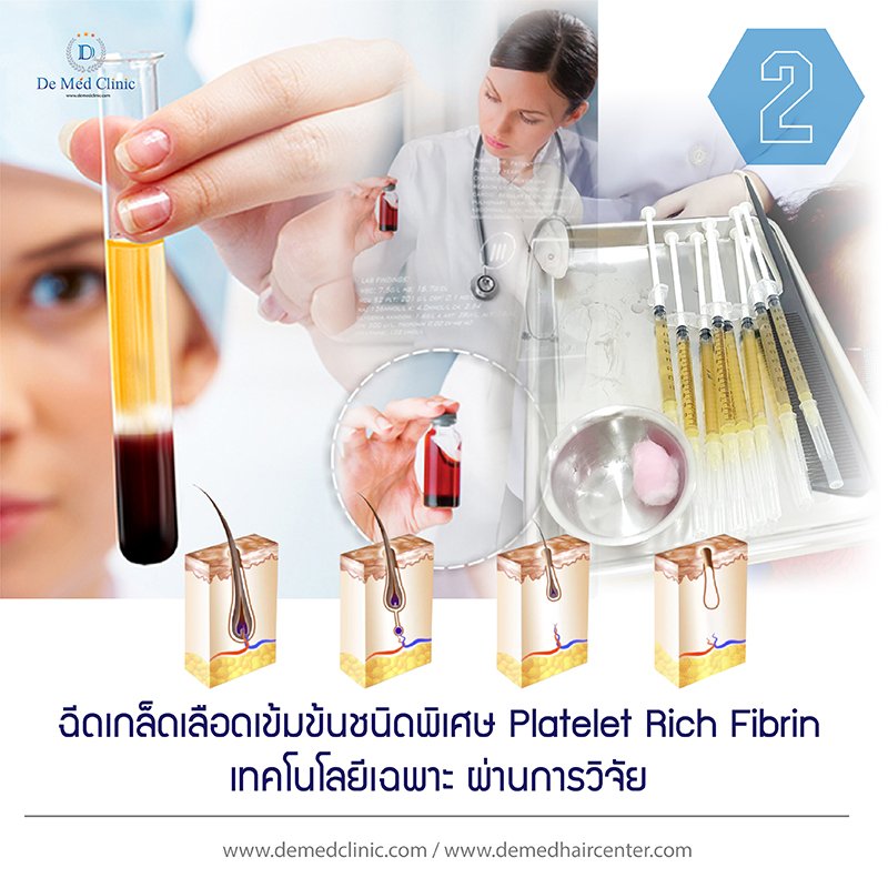 2. ฉีดเกล็ดเลือดเข้มข้นชนิดพิเศษ Platelet Rich Fibrin เทคโนโลยีเฉพาะ ผ่านการวิจัย 