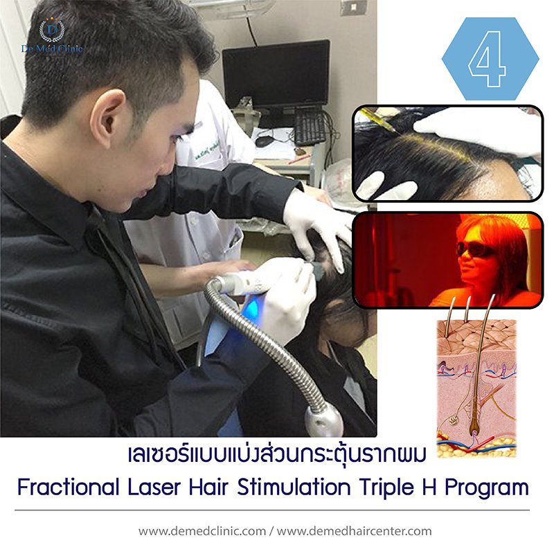 4. เลเซอร์แบบแบ่งส่วนกระตุ้นรากผม Fractional Laser Hair Stimulation Triple H Program 
