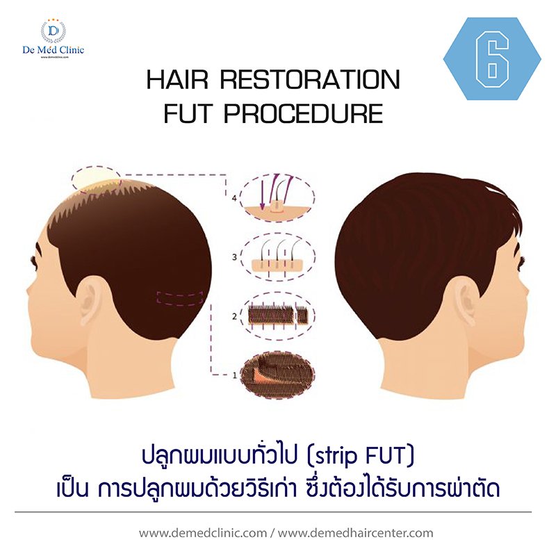 6. ปลูกผมแบบทั่วไป (strip FUT)หรือ Strip Technique เป็น การปลูกผมด้วยวิธีเก่า ซึ่งต้องได้รับการผ่าตัด และเป็นวิธีที่ถูกใช้อย่างแพร่หลายในการปลูกผมมาเป็นเวลานาน 