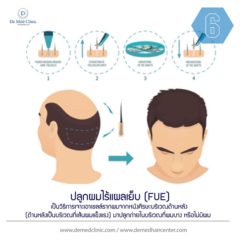 7. ปลูกผมไร้แผลเย็บ (FUE) เป็นวิธีการเจาะเอาเซลล์รากผมจากหนังศีรษะบริเวณด้านหลัง (ด้านหลังเป็นบริเวณที่เส้นผมแข็งแรง) มาปลูกถ่ายในบริเวณที่ผมบาง หรือไม่มีผม 7. ปลูกผมไร้แผลเย็บ (FUE) เป็นวิธีการเจาะเอาเซลล์รากผมจากหนังศีรษะบริเวณด้านหลัง (ด้านหลังเป็นบริเวณที่เส้นผมแข็งแรง) มาปลูกถ่ายในบริเวณที่ผมบาง หรือไม่มีผม