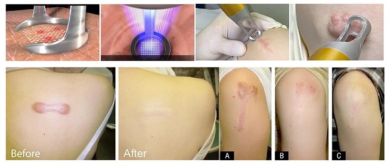 ดูแลแผลเป็นนูนคีลอยด์ ด้วยเทคนิค Fractional Ablative Laser+ทายา*โดยไม่ต้องฉีดยา* :Laser assisted drug delivery ดูแลแผลเป็นนูนคีลอยด์ ด้วยเทคนิค Fractional Ablative Laser+ทายา*โดยไม่ต้องฉีดยา* :Laser assisted drug delivery